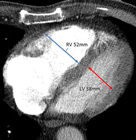 rv lv ratio ctpa